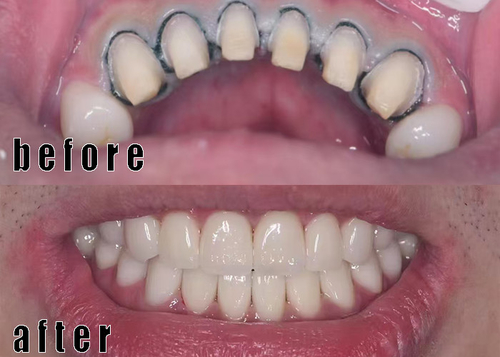 крона zirconia