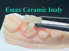 Вкладыш Emax Ceramic, который специально сделан для его назначенного положения