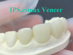 EMAX Veneer - идеальное решение для долговечных и эстетичных зубных реставраций