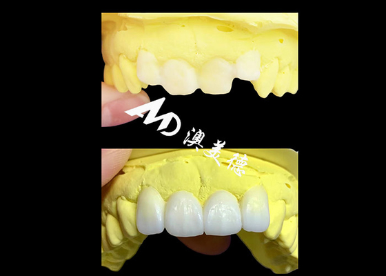 Купить Заказ прозрачные циркониевые зубные короны изготовлены AMD Dental Lab online manufacture
