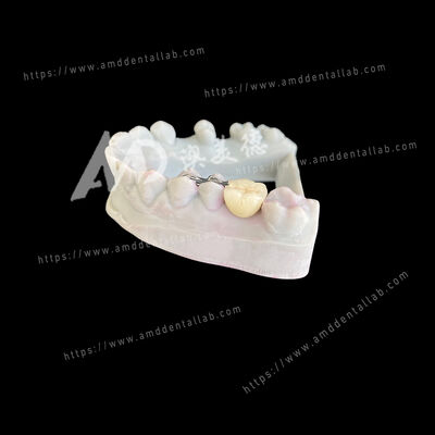 Купить PFM Maryland Bridge One Pontic Two Wings Консервативное и эстетическое решение online manufacture