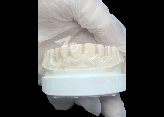 IPS Emax Veneers Minimal Prep/ No-prep Veneers являются инновационными решениями для красивой улыбки