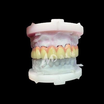 Хорошая цена Чисто титановая керамическая коронка и мостовидный протез. Прочные, легкие, эстетичные реставрации онлайн